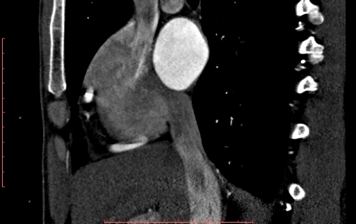 File:Anomalous left coronary artery from the pulmonary artery (ALCAPA) (Radiopaedia 70148-80181 C 50).jpg