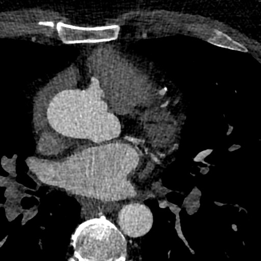File:Anomalous origin of the left coronary artery with malignant course (Radiopaedia 77842-90126 C 48).jpeg