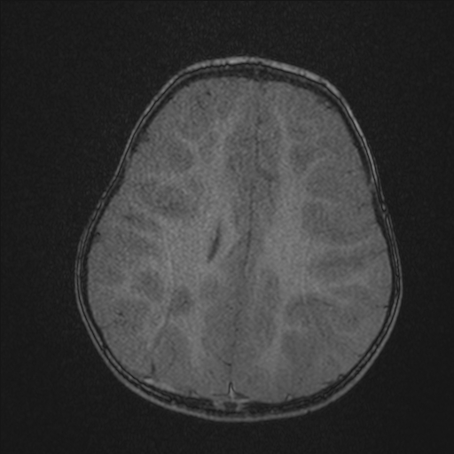 Anoxic brain injury (Radiopaedia 79165-92139 Axial MRA 177).jpg