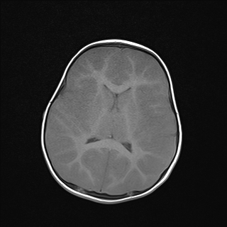 File:Anoxic brain injury (Radiopaedia 79165-92139 Axial T1 16).jpg