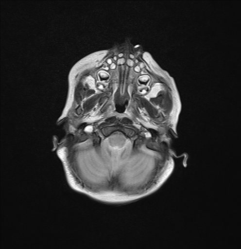 File:Anoxic brain injury (Radiopaedia 79165-92139 Axial T2 5).jpg