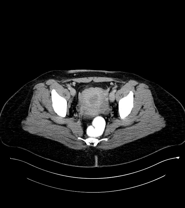 Anterior abdominal wall CSF pseudocyst (CSFoma) (Radiopaedia 79453-92571 A 81).jpg