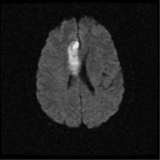 File:Anterior cerebral artery territory infarct (Radiopaedia 39327-41584 Axial DWI 16).png