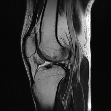 File:Anterior cruciate ligament full thickness tear (Radiopaedia 66268-75467 Sagittal T2 14).jpg