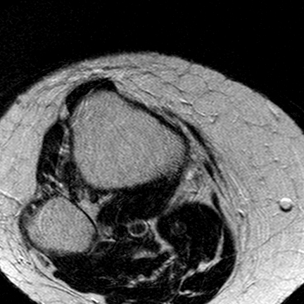 File:Anterior cruciate ligament mucoid degeneration (Radiopaedia 60853-68633 Axial T2 5).jpg