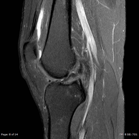 File:Anterior cruciate ligament tear (Radiopaedia 70783-80964 Sagittal PD fat sat 8).jpg