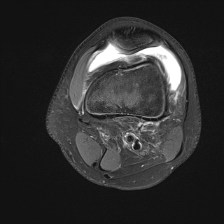 File:Anterior cruciate ligament tear - pediatric (Radiopaedia 62152-70260 Axial PD fat sat 7).jpg