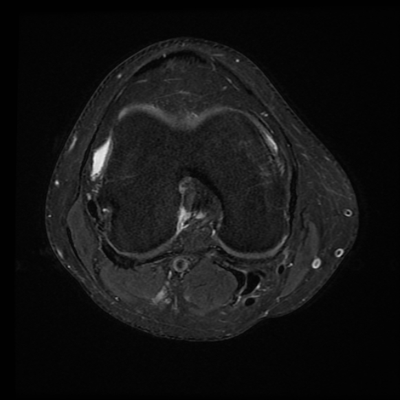 File:Anterior cruciate ligament tear with posteromedial corner injury, bucket-handle meniscal tear and chondral delamination (Radiopaedia 75501-86744 Axial PD fat sat 13).jpg