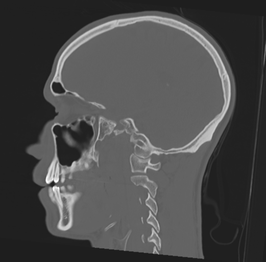 Anterior nasal spine fracture (Radiopaedia 46138-50494 Sagittal bone window 23).png
