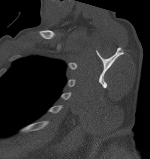 Anterior shoulder dislocation with Hill-Sachs and bony Bankart lesions (Radiopaedia 40424-42974 Sagittal bone window 35).png