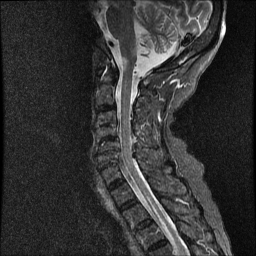 File:Anterior spinal artery syndrome (Radiopaedia 46335-50750 Sagittal STIR 6).png