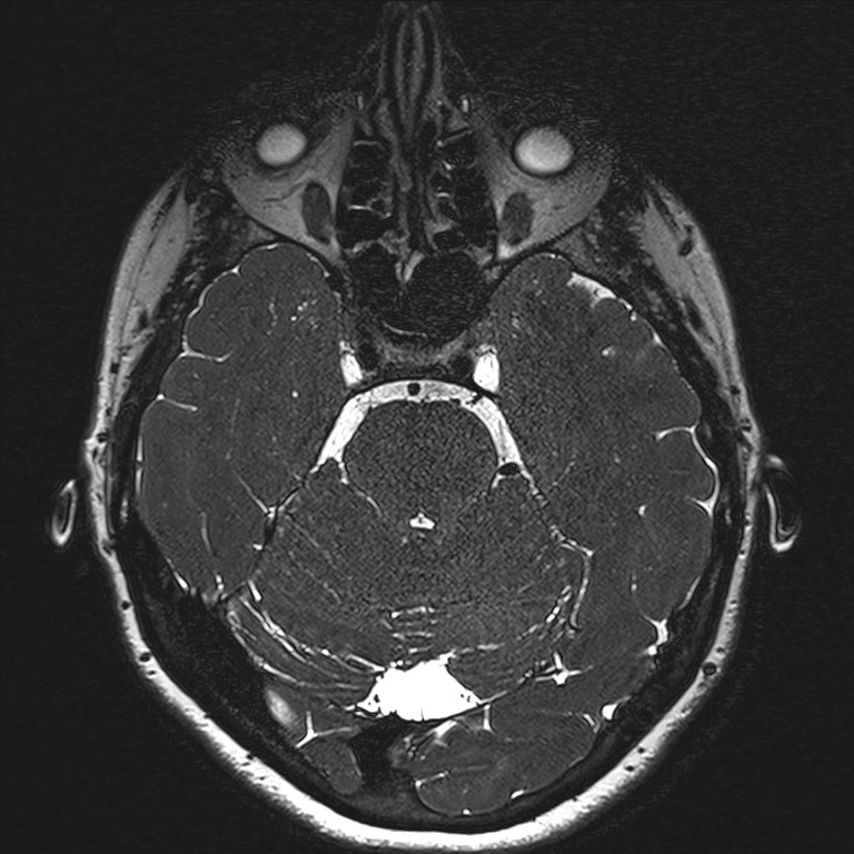 Anterior temporal encephalocele (Radiopaedia 82624-96808 Axial T2 high res 52).jpg
