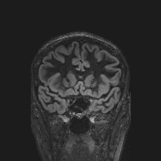 Anterior temporal encephalocele (Radiopaedia 82624-96808 Coronal FLAIR 17).jpg