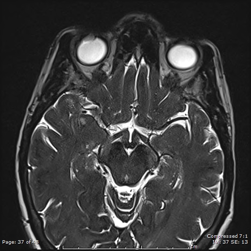 File:Anterior temporal lobe perivascular space (Radiopaedia 88283-104914 C 28).jpg