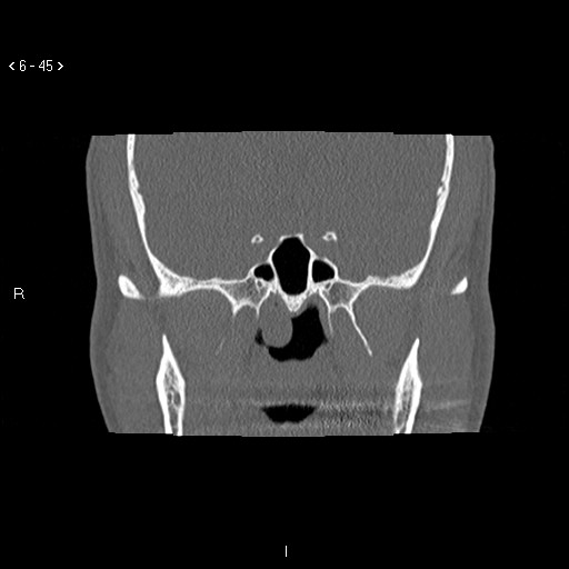 File:Antrochoanal Polyp (Radiopaedia 70510-80631 Coronal bone window 34).jpg