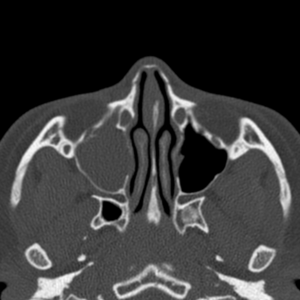 Antrochoanal polyp (Radiopaedia 33984-35202 Axial bone window 33).jpg