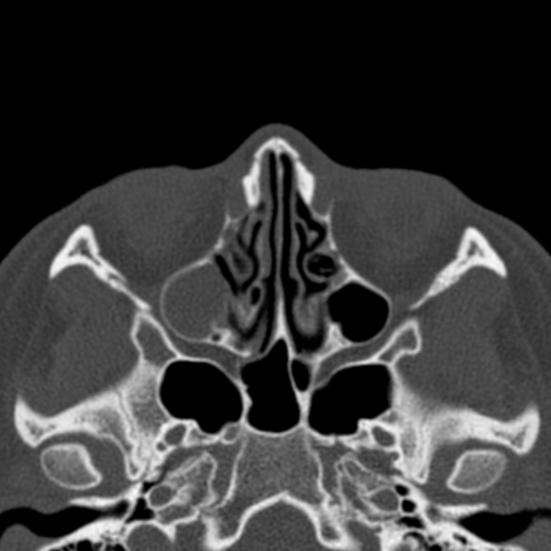Antrochoanal polyp (Radiopaedia 33984-35202 Axial bone window 40).jpg