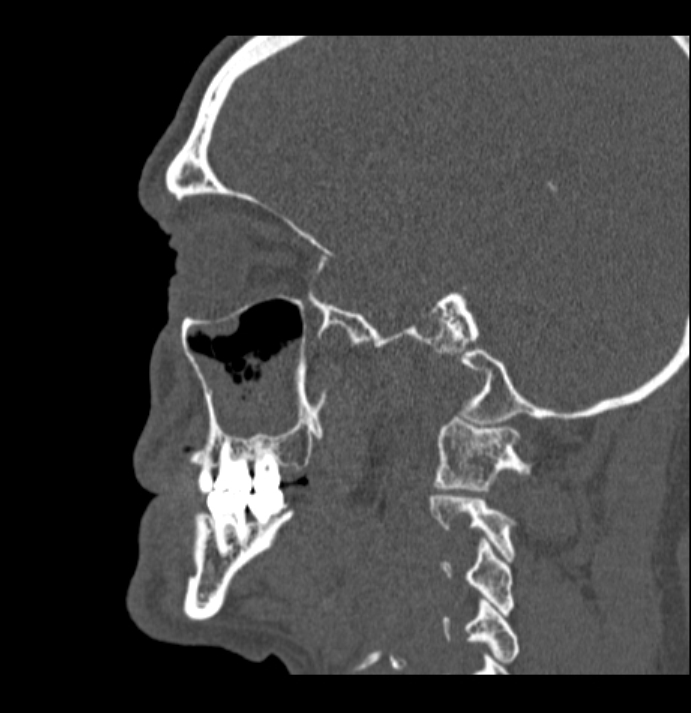 Antrochoanal polyp (Radiopaedia 79011-92169 Sagittal bone window 5).jpg