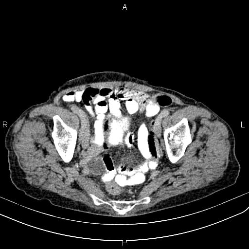 Aortic aneurysm and Lemmel syndrome (Radiopaedia 86499-102554 Axial C+ delayed 67).jpg
