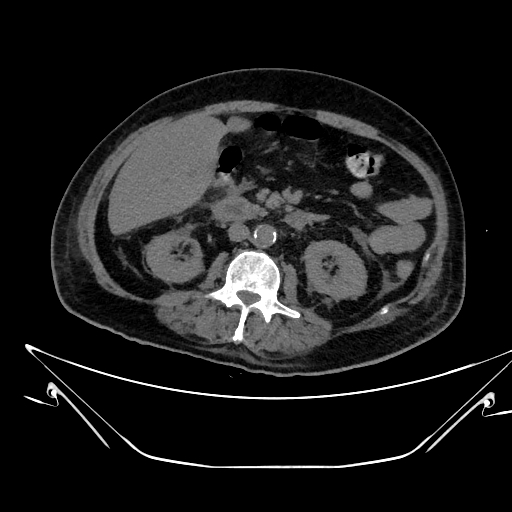 Aortic arch aneurysm (Radiopaedia 84109-99365 Axial non-contrast 348).jpg