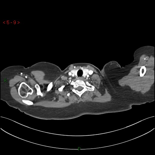 Aortic arch origin of left vertebral artery (Radiopaedia 51520-57286 A 8).jpg