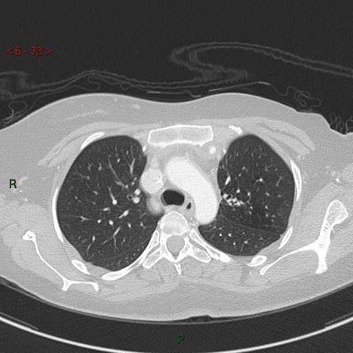 Aortic arch origin of left vertebral artery (Radiopaedia 51520-57286 Axial lung window 73).jpg
