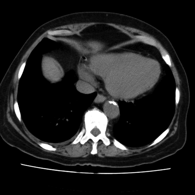 Aortic arch pseudoaneurysm (Radiopaedia 8534-9368 Axial non-contrast 55).jpg