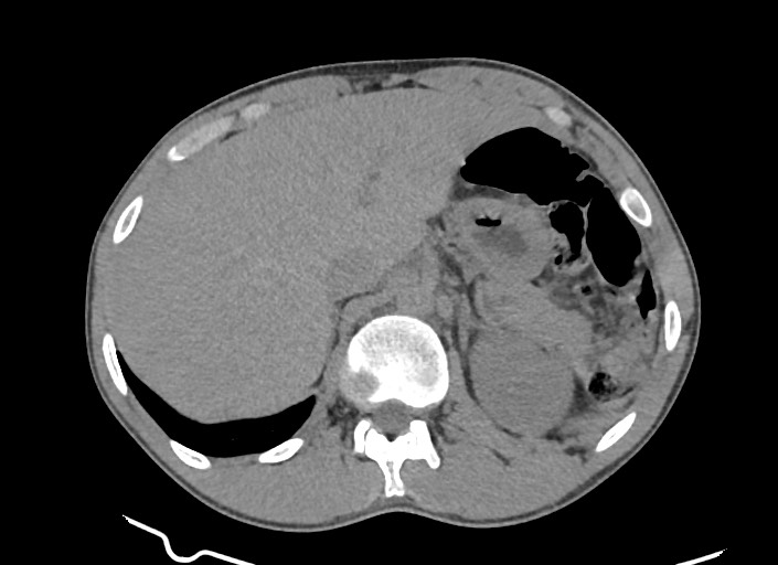 File:Aortic coarctation with aneurysm (Radiopaedia 74818-85828 A 29).jpg