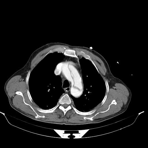 Aortic dissection- Stanford type A (Radiopaedia 22085-22085 A 15).jpg