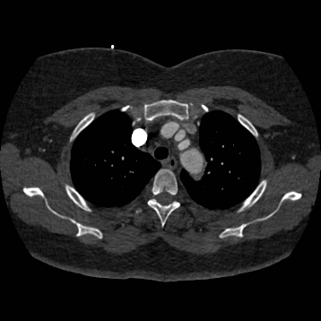 Aortic dissection (Radiopaedia 57969-64959 A 77).jpg