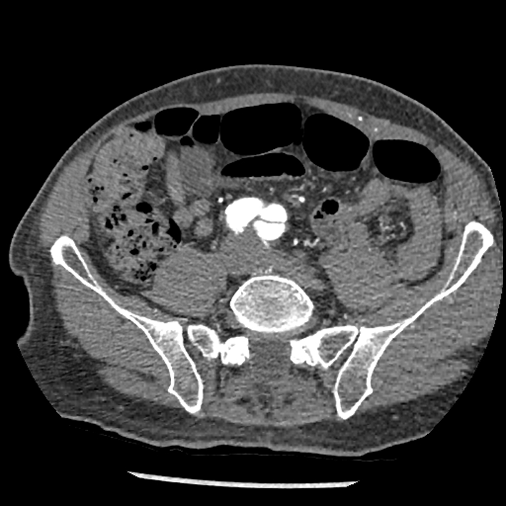Aortic dissection - DeBakey Type I-Stanford A (Radiopaedia 79863-93115 A 66).jpg