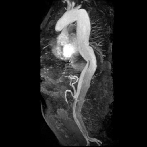 File:Aortic dissection - Stanford A - DeBakey I (Radiopaedia 23469-23551 MRA 21).jpg
