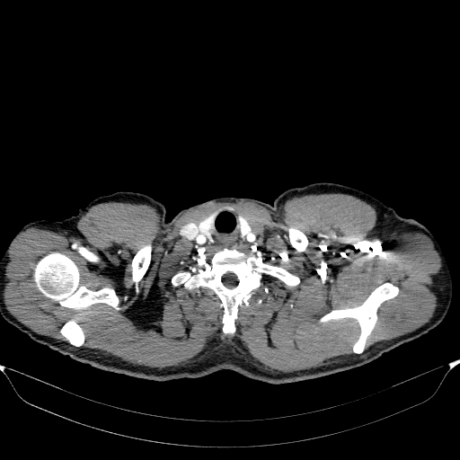 Aortic dissection - Stanford type A (Radiopaedia 83418-98500 A 3).jpg