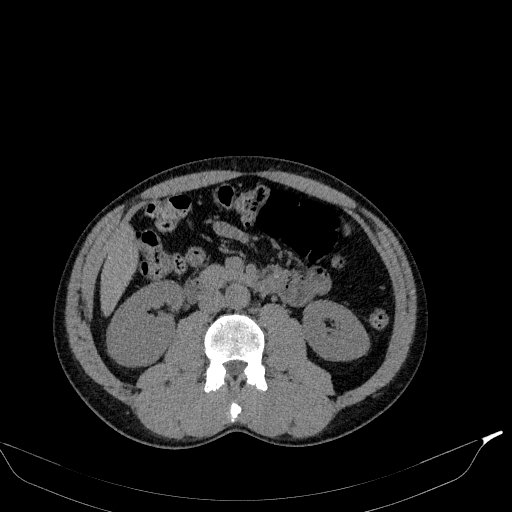 File:Aortic dissection - Stanford type A (Radiopaedia 83418-98500 Axial non-contrast 56).jpg