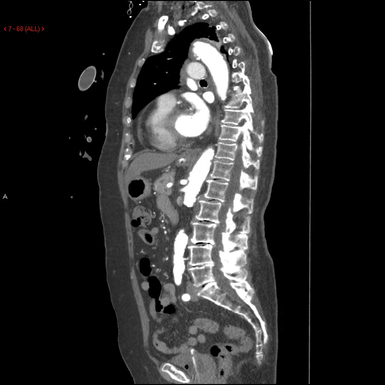 Aortic intramural hematoma (Radiopaedia 27746-28001 C 37).jpg