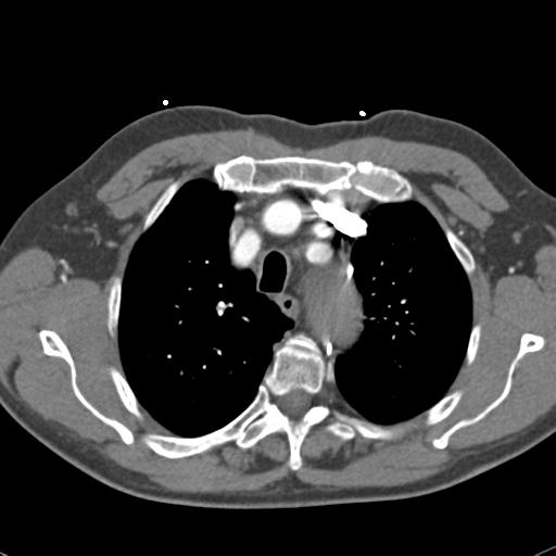 File:Aortic intramural hematoma (Radiopaedia 31139-31838 B 22).jpg