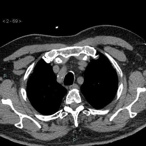 Aortic intramural hematoma (Radiopaedia 48463-53380 Axial non-contrast 31).jpg