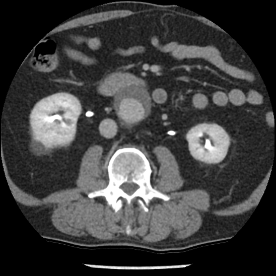 Aortic intramural hematoma (type B) (Radiopaedia 79323-92387 Axial C+ delayed 74).jpg