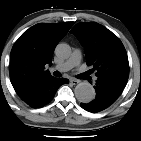 Aortic intramural hematoma (type B) (Radiopaedia 79323-92387 Axial non-contrast 23).jpg