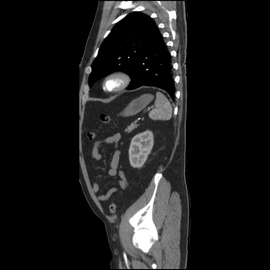 Aortic intramural hematoma (type B) (Radiopaedia 79323-92387 H 44).jpg