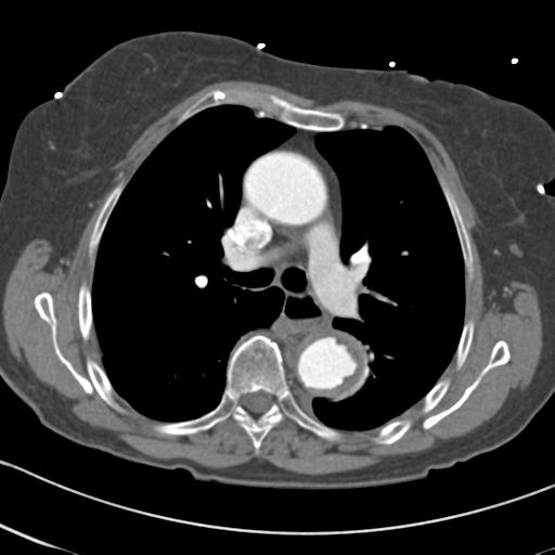 Aortic intramural hematoma from penetrating atherosclerotic ulcer (Radiopaedia 31137-31836 A 32).jpg