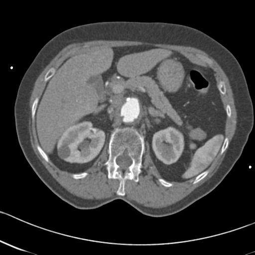 Aortic intramural hematoma from penetrating atherosclerotic ulcer (Radiopaedia 31137-31836 A 88).jpg