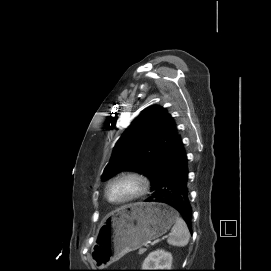 Aortic intramural hematoma with dissection and intramural blood pool (Radiopaedia 77373-89491 D 72).jpg