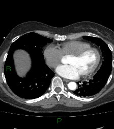 Aortic valve endocarditis (Radiopaedia 87209-103485 C 63).jpg