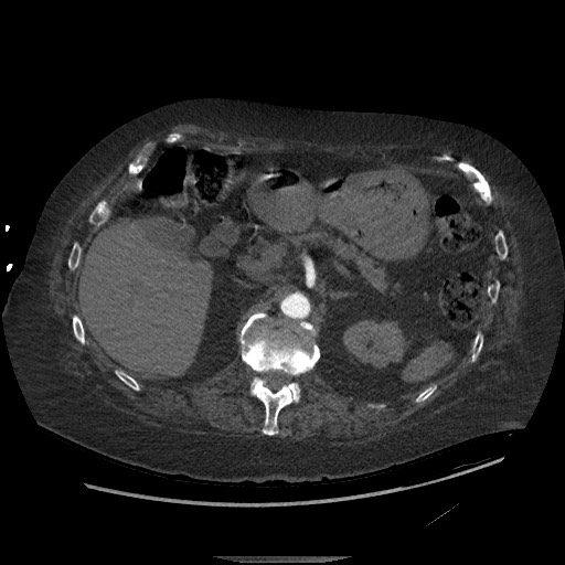 Aortoesophageal fistula with endovascular repair (Radiopaedia 73781-84592 Axial C+ CTPA 197).jpg