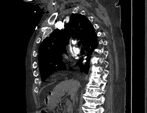 Aortoesophageal fistula with endovascular repair (Radiopaedia 73781-84592 Sagittal C+ CTPA 79).jpg