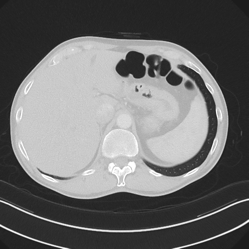 Apical pleural calcification (Radiopaedia 46141-50499 Axial lung window 67).png