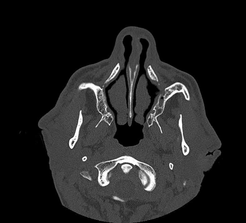 Aplastic maxillary sinuses (Radiopaedia 60030-67561 Axial non-contrast 19).jpg