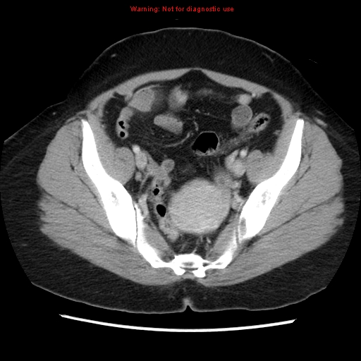 Appendiceal mucinous cystadenoma (Radiopaedia 8263-9111 Axial liver window 66).jpg