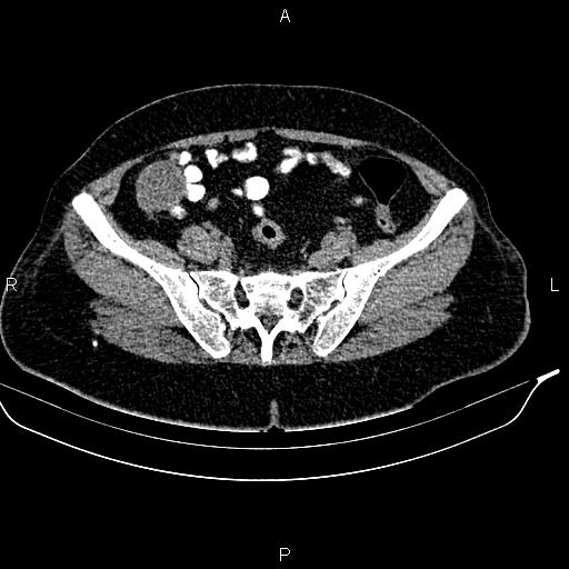 Appendiceal mucocele (Radiopaedia 83147-97518 A 32).jpg